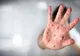 Ministerul Sănătății a declarat epidemie de rujeolă la nivel național